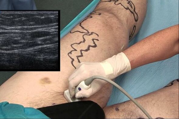 gizonen barizeen diagnostikoa