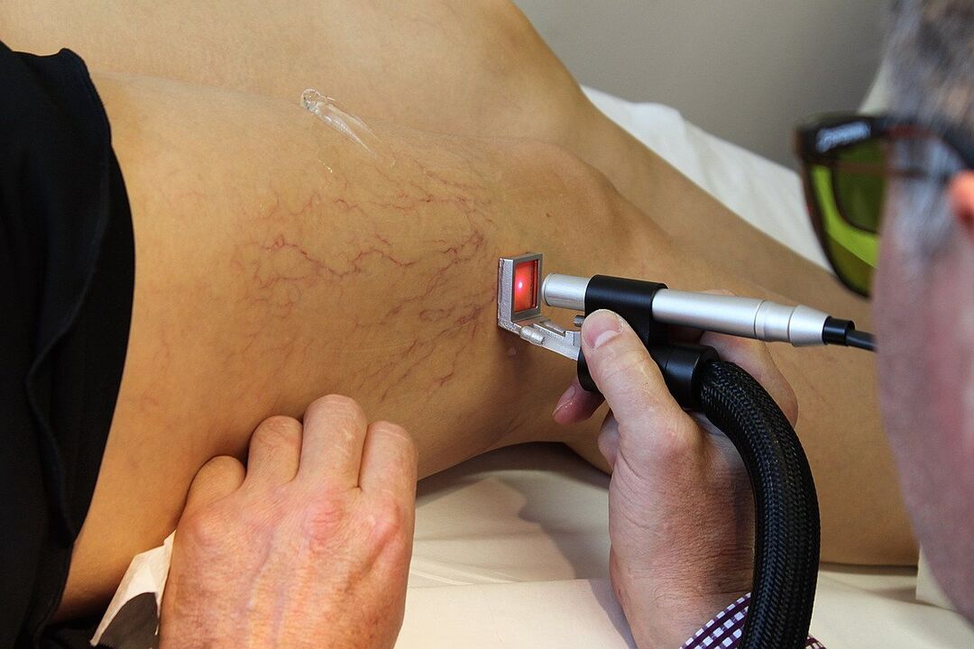 Laser koagulazioa