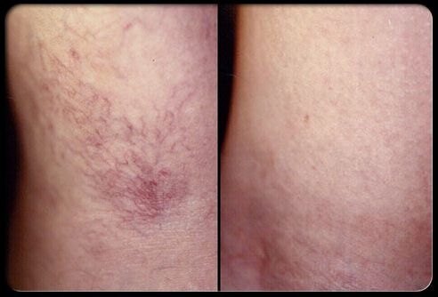 Eskleroterapia aurretik eta ondoren