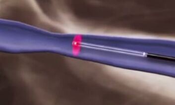 Tratamendu termikoak