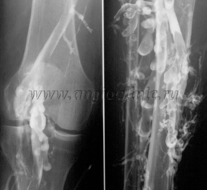 Ultrasoinu eskaneatzea